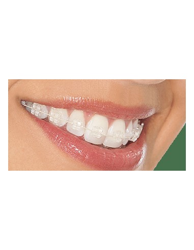 Ortodoncia estética (brackets de zafiro)